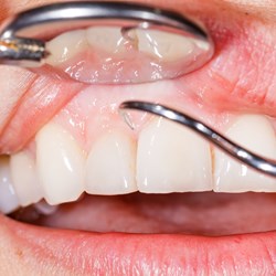 Image for Diabetes and Gum Disease