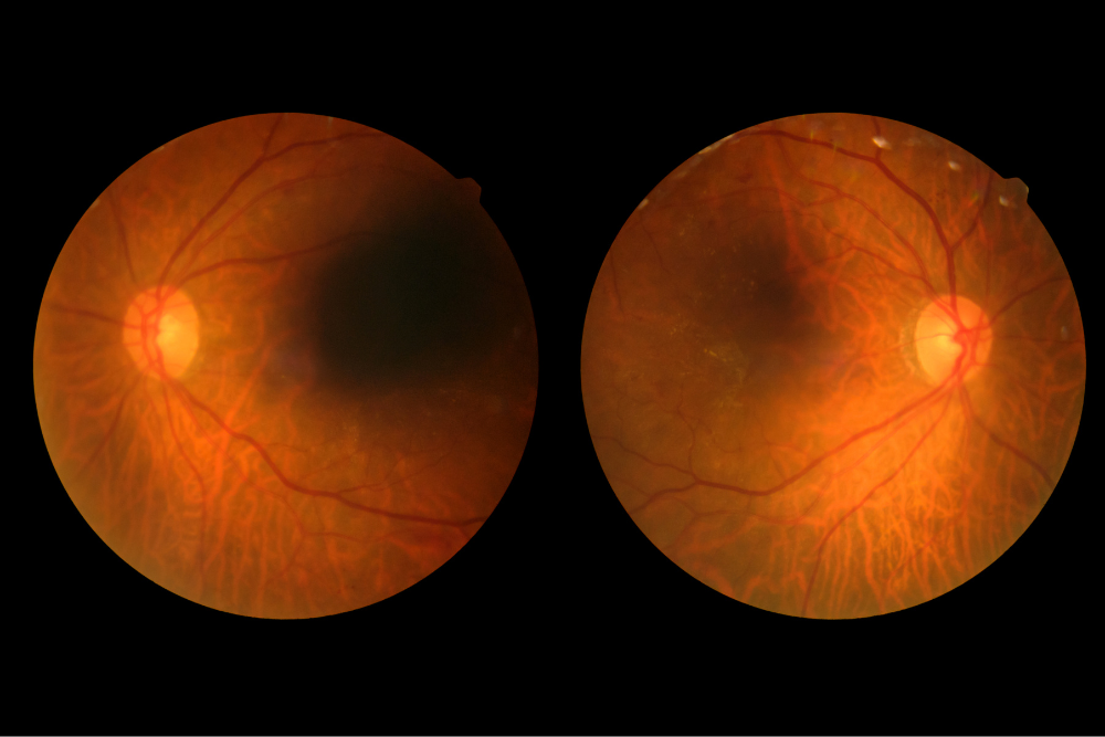 Closer monitoring and treatment of diabetic retinopathy