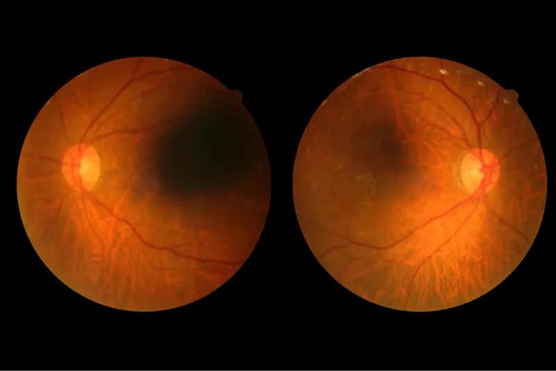 Closer monitoring and treatment of diabetic retinopathy