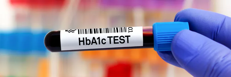 Non Diabetic Hyperglycaemia (NDH)