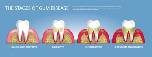 Gum disease stages.jpg