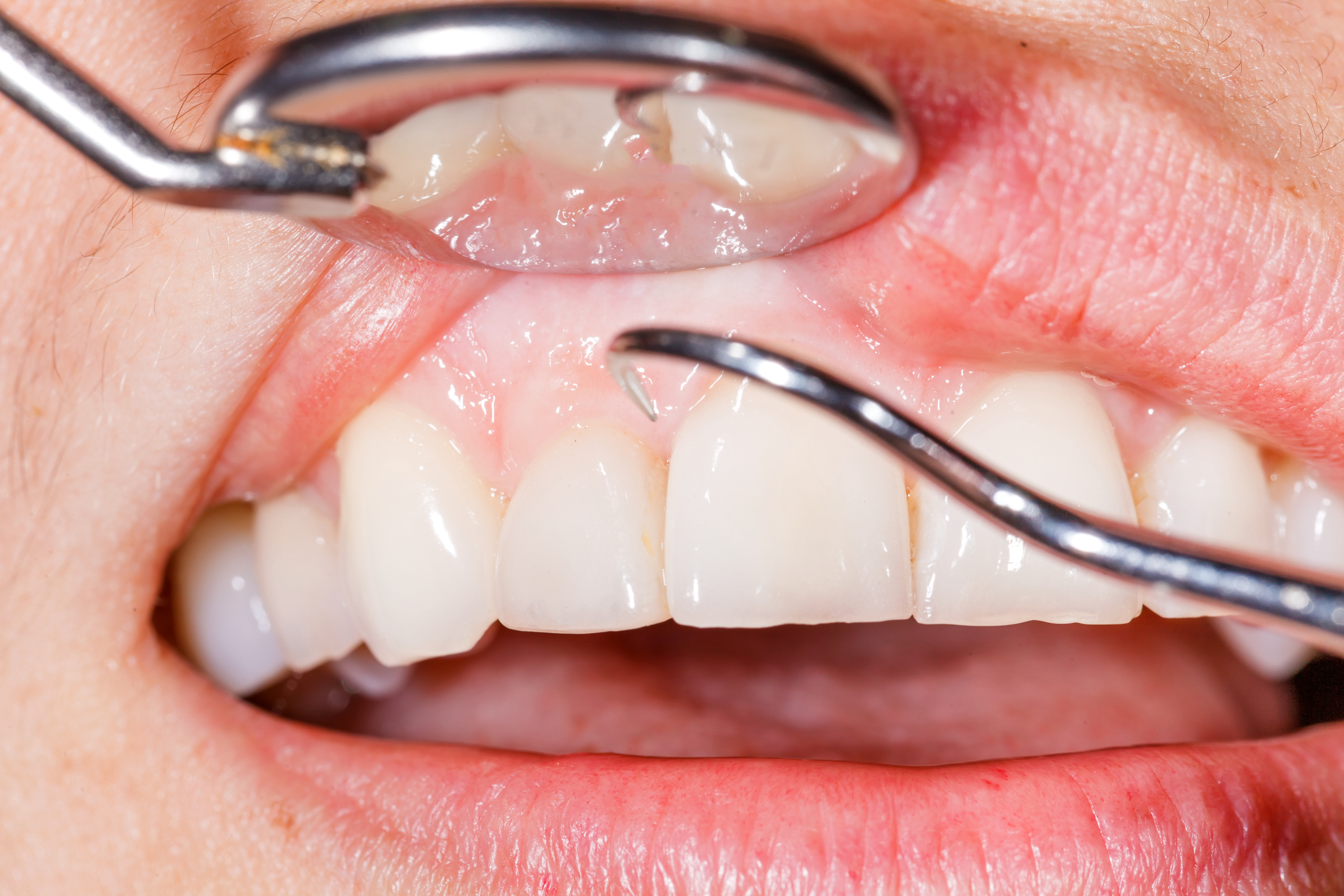 Diabetes and Gum Disease