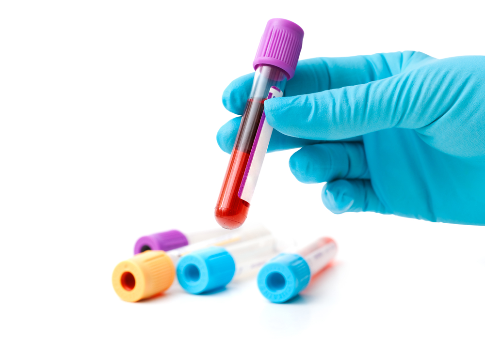 Non-diabetic hyperglycaemia (pre-diabetes)