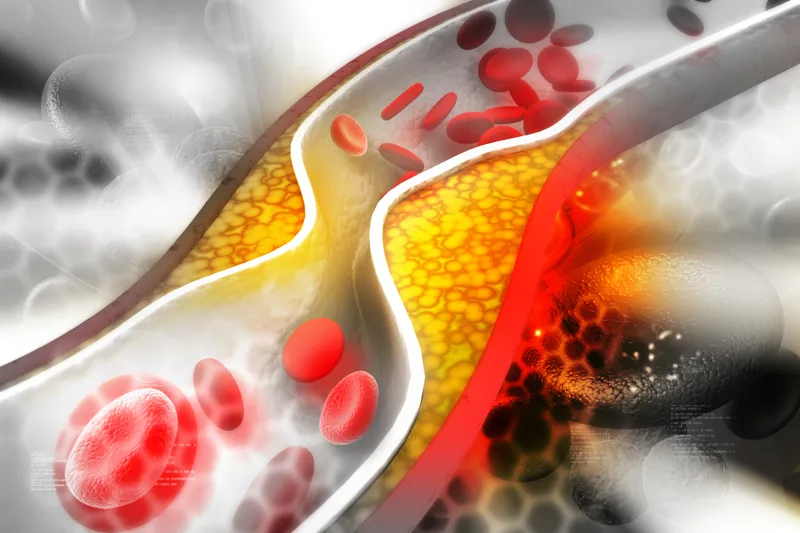 Cholesterol, reducing your risk of complications