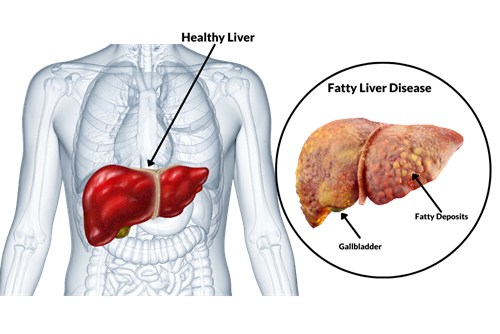 A normal liver next to a fatty liver (MASLD)